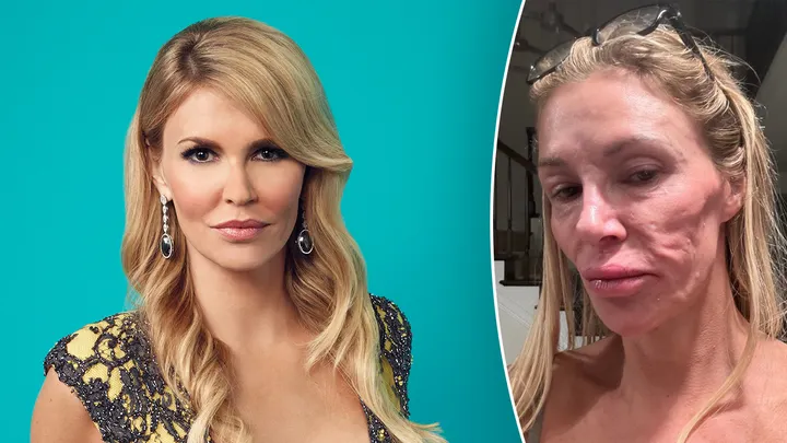 Brandi Glanville compartilha foto despojada e revela problemas de saúde misteriosos: “Meus olhos estão arruinados”